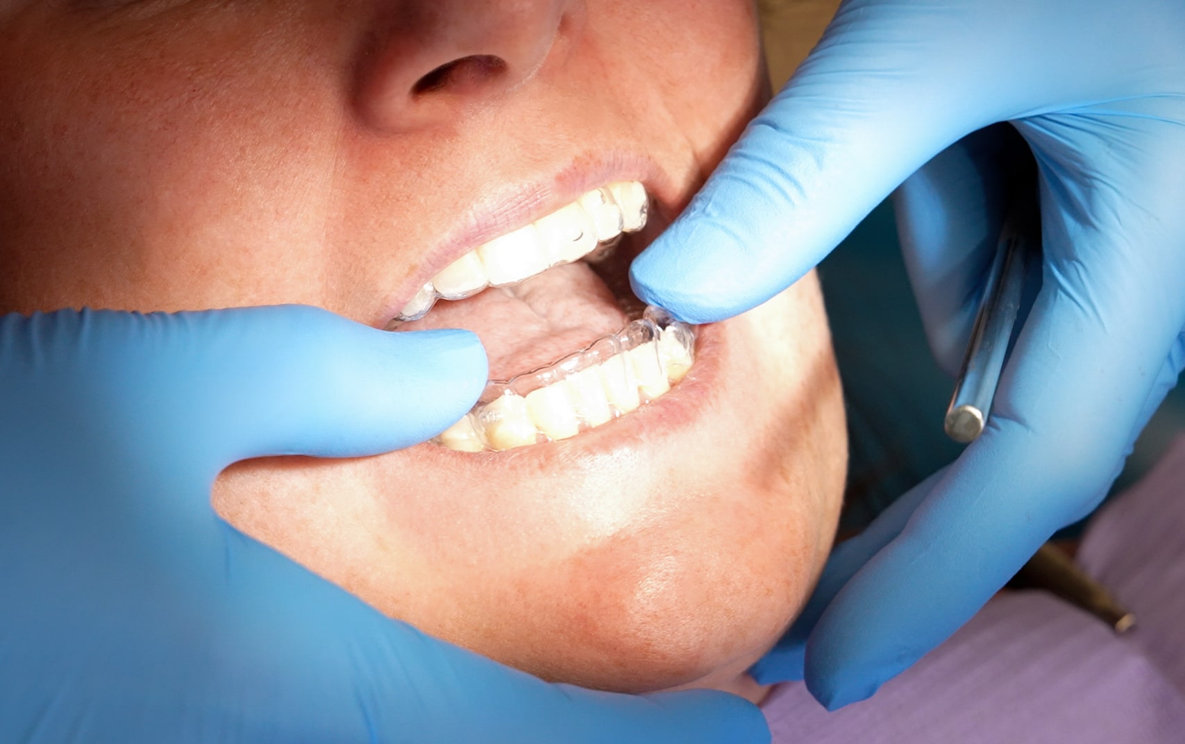 Ortodòncia a La Bisbal d'Empordà - Clínica dental - Gironella & Maynau