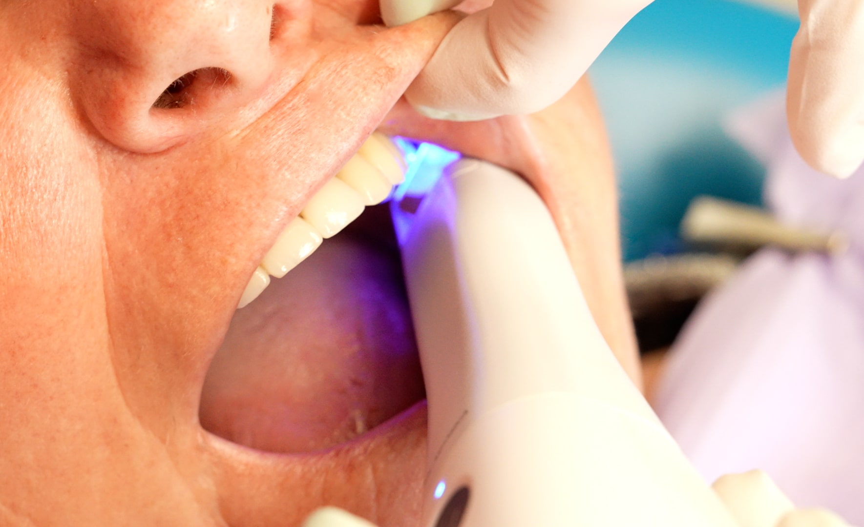 Estètica Dental a La Bisbal d'Empordà - Gironella & Maynau